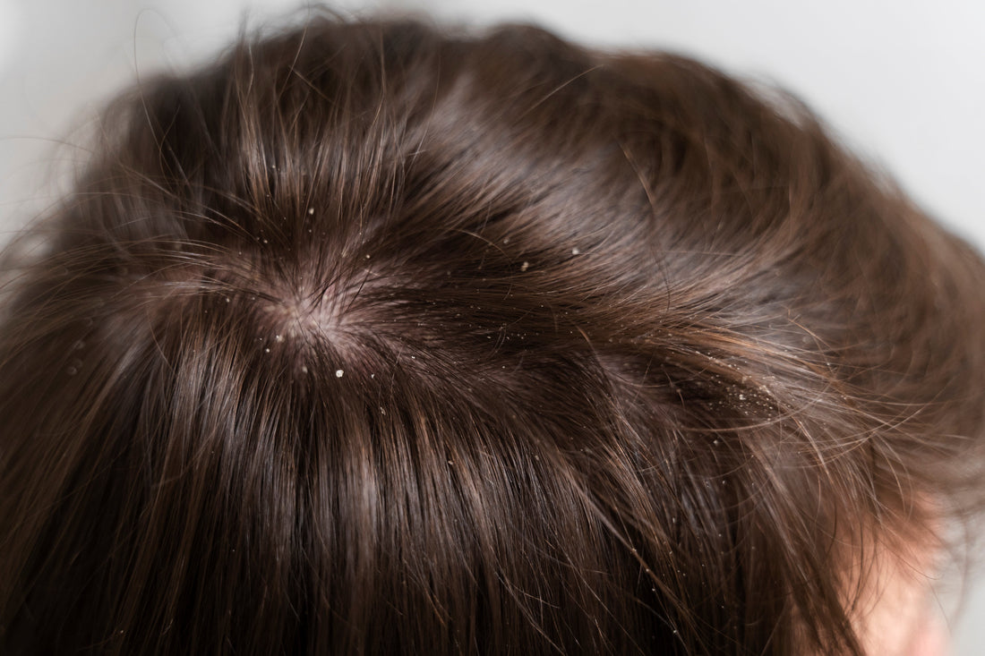 “6 External Causes of Dandruff (+ When to Suspect an Internal Issue)”